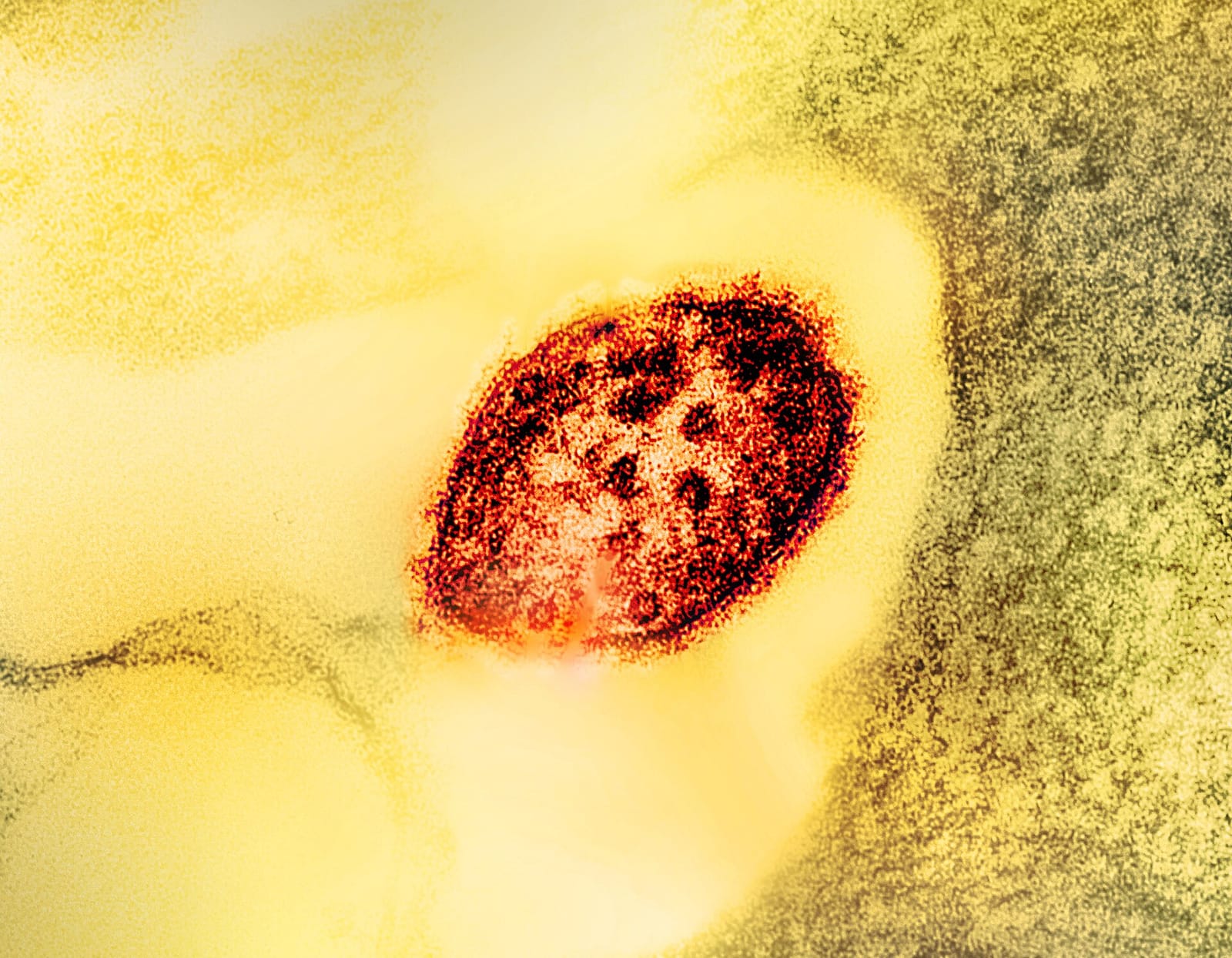 File photo: Colorized electron micrograph of a measles virus particle